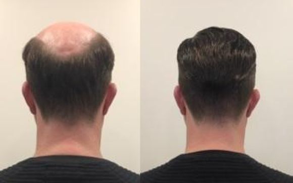 dun haar