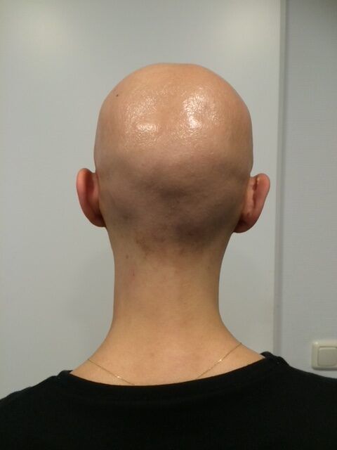 Voor foto alopecia totalis