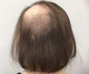 voorbeeld Alopecia Areata