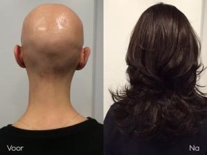 Alopecia Totalis